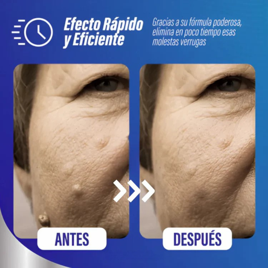 AntiWart® Crema Removedor de Verrugas Potente – Resultados Visibles